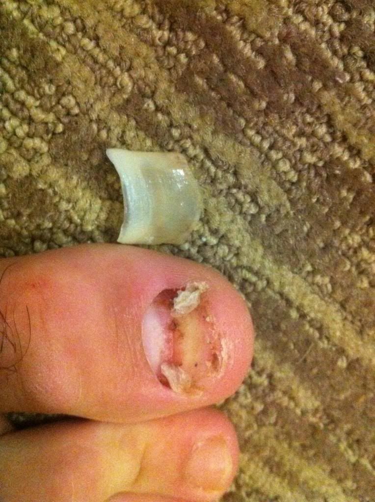 Just ripped off my big toenail (large pic) Forums