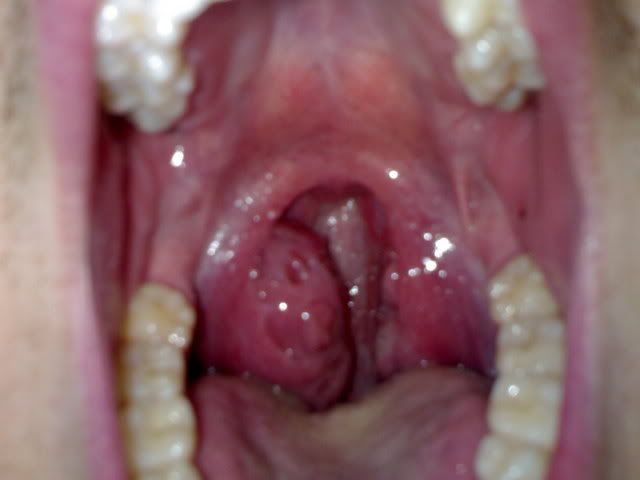 Adult Tonsils Removed 94
